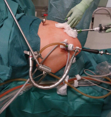 FAP in Gastric Sleeve resection