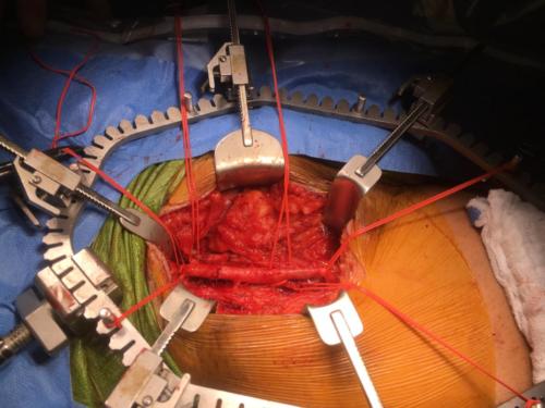 Femoral Endarterectomy (1)