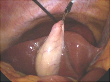 Gallbladder Retraction