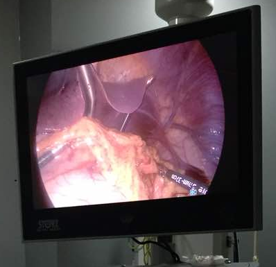 Laparoscopic View Nath. Hook