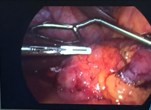 LaproFlex - Liver Retraction