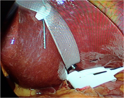 Liver Retraction-1
