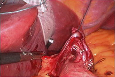 Liver Retration
