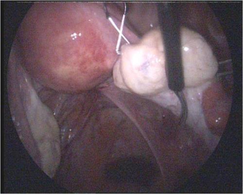 Ovarian Cyst