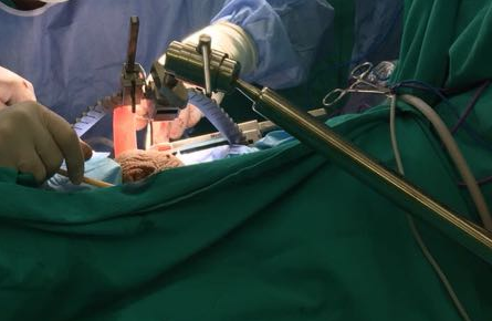 Prostatectomy