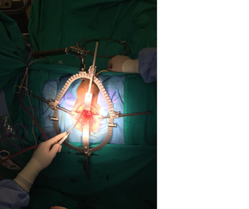 Prostatectomy w - SA