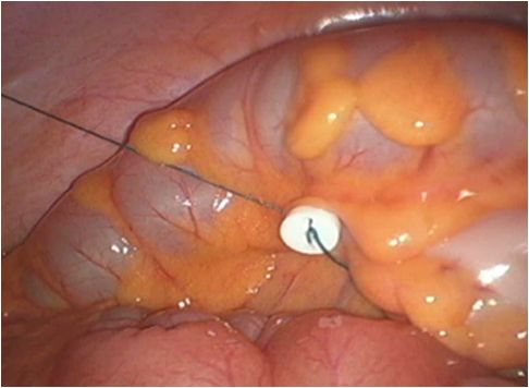 Sigmoid Colon