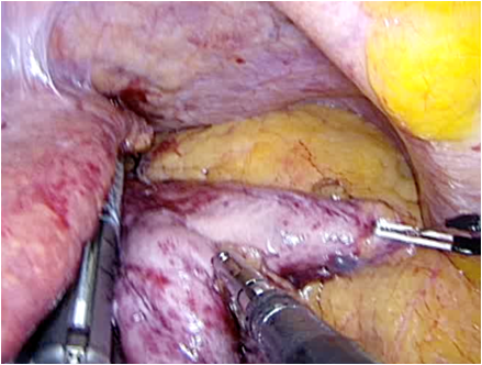 Sleeve Gastrectomy