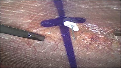 Temporary Mesh Positioning