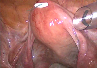 Uterus Retraction