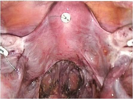 Uterus adn Adnexa Suspension-2