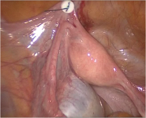 Uterus adn Adnexa Suspension